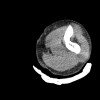 SPORK, NICO - 22.03.1976 - 02.08.2022 - CT obere Extremität - 17:56:57